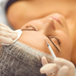 Tratamento com Toxina botulínica. Serve para tratamento de rugas, linhas de expressão, linhas marcadas no rosto, pé de galinha, bigode chinês, código de barras. Melhora o aspecto da linha do sorriso, da linha do olho e das rugas na sobrancelha ou na testa.