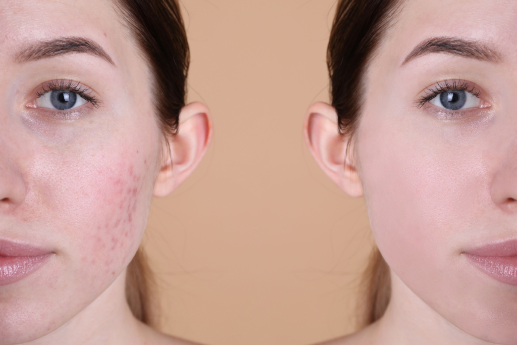 Tratamento para acne. Acne mulher. Espinhas. Tratamento para espinhas. Dra. Marcela Junqueira Dermatologista em Juiz de Fora. Tricologista em Juiz de Fora.