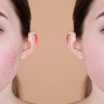 Tratamento para acne. Acne mulher. Espinhas. Tratamento para espinhas. Dra. Marcela Junqueira Dermatologista em Juiz de Fora. Tricologista em Juiz de Fora.
